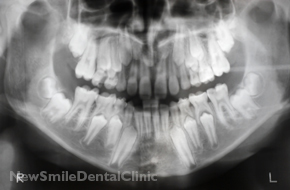 X Ray of Jaw