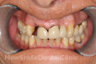 Case 1 - Before Treatment