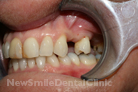 Case 2 - Before Treatment