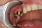 Case 3 - Before Treatment