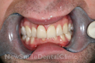 Case 4 - After Treatment