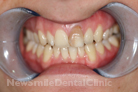 Case 1 - Before Treatment