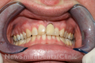 Case 11 - Before Treatment