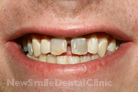 Case 12 - Before Treatment