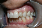 Case 2 - Before Treatment