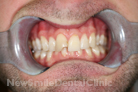 Case 4 - Before Treatment
