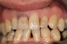 Case 5 - Before Treatment