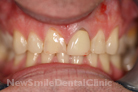 Case 6 - Before Treatment