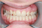 Case 9 - Before Treatment