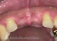 Dental Implants Case