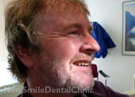 Dental Implants Case