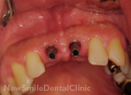 Dental Implants Case
