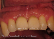 Dental Implants Case