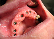 Dental Implants Case