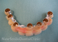 Dental Implants Case