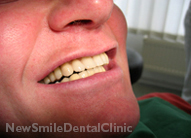 Dental Implants Case