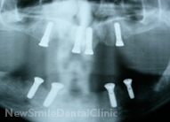 Dental Implants Case