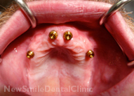 Dental Implants Case