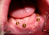 Dental Implants Case