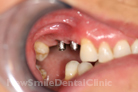 Case 1 - Before Treatment