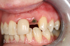 Case 2 - Before Treatment