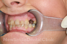 Case 3 - Before Treatment