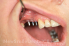 Case 4 - Before Treatment