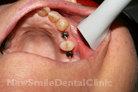 Case 5 - Before Treatment