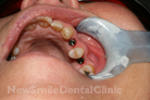 Case 5 - Before Treatment