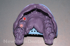 Case 5 - Implant Mould