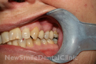 Case 5 - After Treatment