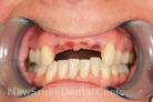 Case 6 - Before Treatment