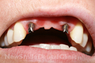 Case 6 - Abutments in Position