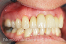 Case 6 - After Treatment