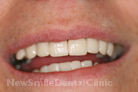 Case 4 - After Treatment