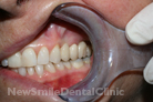 Case 3 - After Treatment