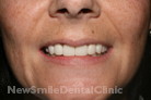 Case 1 - Veneers: After Treatment