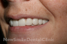Case 1 - Veneers: After Treatment