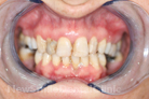 Case 4 - Before Treatment