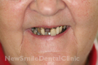 Case 2 - Before Treatment