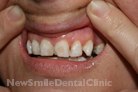 Case 1 - Veneers: Before Treatment