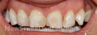 Case 1 - Veneers: Before Treatment