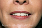 Case 6 - After Treatment