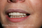 Case 6 - After Treatment
