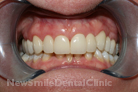 Case 5 - After Treatment
