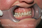 Case 5 - Before Treatment