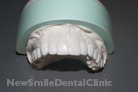 Case 5 - Diagnostic Wax Up