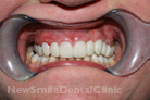 Case 5 - Temporary crowns placed using matrix made on diagnostic wax up model