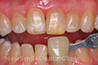 Case 2 - Before Treatment