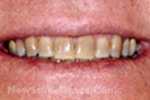 Case 4 - Before Treatment